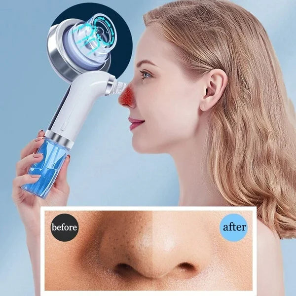 Water Cycle Blackhead & Pore Vacuum